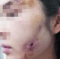 女子在郑州一美容院做完“脂肪填充”脸上溃洞流脓 还被店主、手术医生拉黑 - 河南一百度