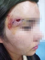女子在郑州一美容院做完“脂肪填充”脸上溃洞流脓 还被店主、手术医生拉黑 - 河南一百度