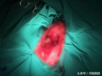 郑州一工人胸口被钢管刺出“大窟窿”，医生却说是不幸中的万幸 - 河南一百度
