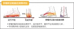 扁平足伴足外翻，什么年龄穿矫正鞋干预效果最佳 - 郑州新闻热线
