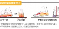 治疗足底筋膜炎 儿童矫正鞋去哪买 - 郑州新闻热线