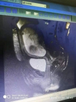 郑州一女子怀孕不足四月，肚子却大得像怀胎十月，连妇产科医师都吓了一跳 - 河南一百度